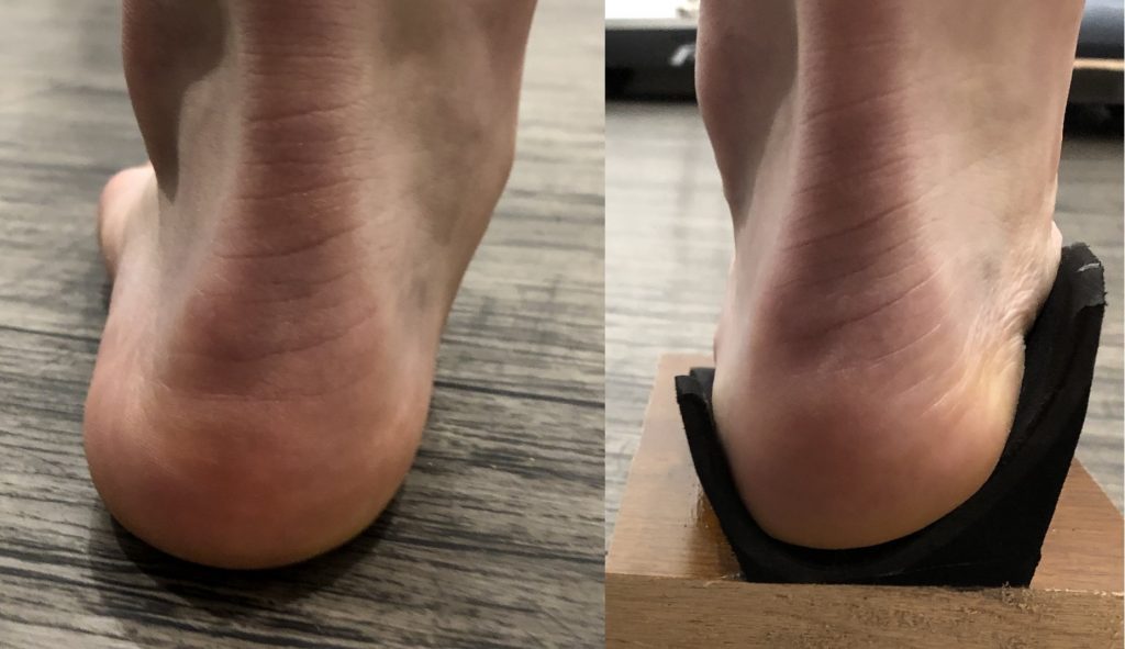 Flat-foot-orthotics.jpg